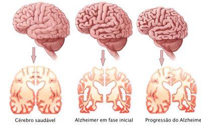 Saúde | Demência