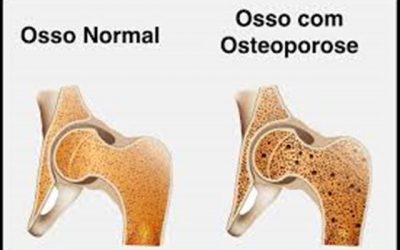 Saúde | Dia Mundial da Osteoporose